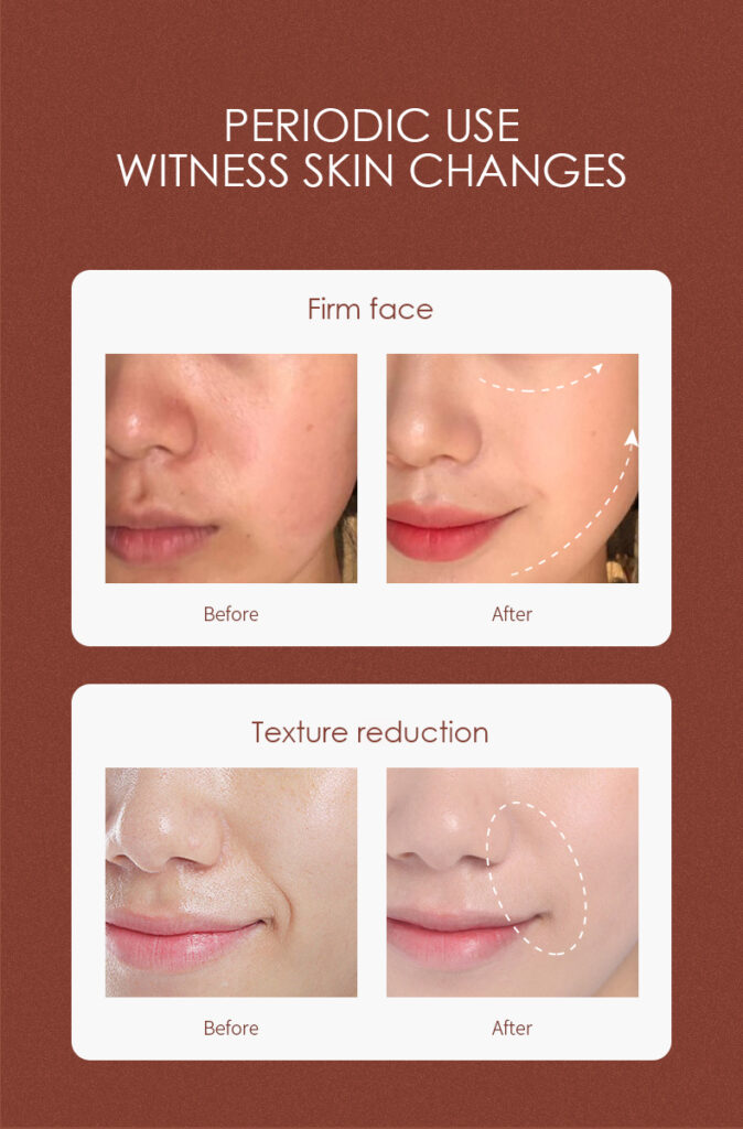 FACIAL BEAUTY INSTRUMENT TAGS: HOME RF BEAUTY DEVICE, HOME RF BEAUTY EQUIPMENT, HOME RF BEAUTY MACHINE, RF BEAUTY DEVICE, RF BEAUTY EQUIPMENT, RF BEAUTY MACHINE